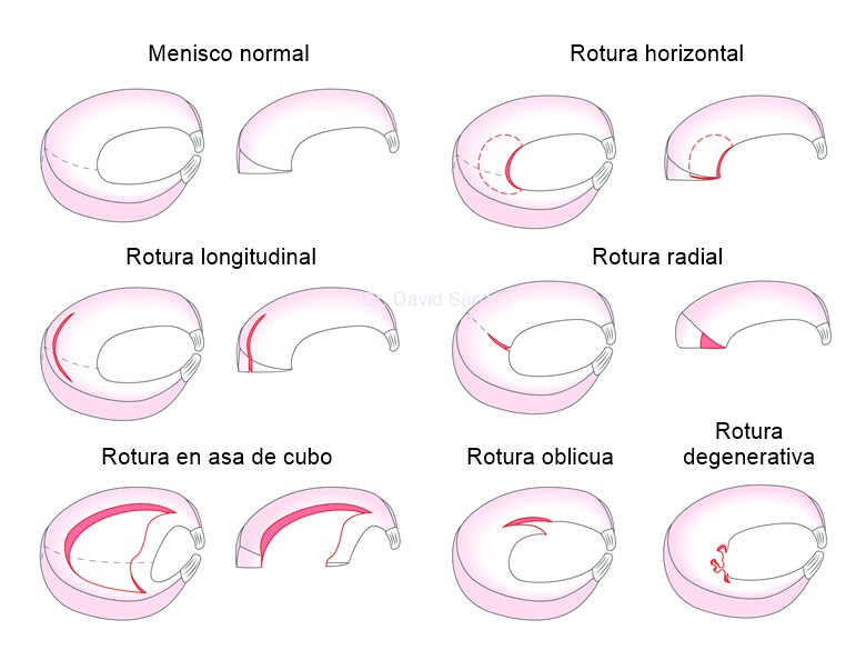 Imagenes sobre los distintos tipos de roturas del menisco