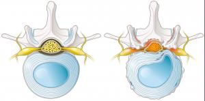 Hernia-Discal-Sintomas-Diagnostico-y-Tratamiento-scaled