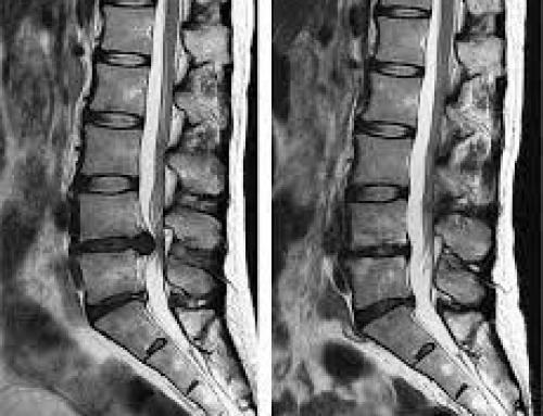Reabsorción Espontánea de la Hernia Discal: Mecanismos Naturales, Tiempo de Recuperación y Tratamientos Conservadores