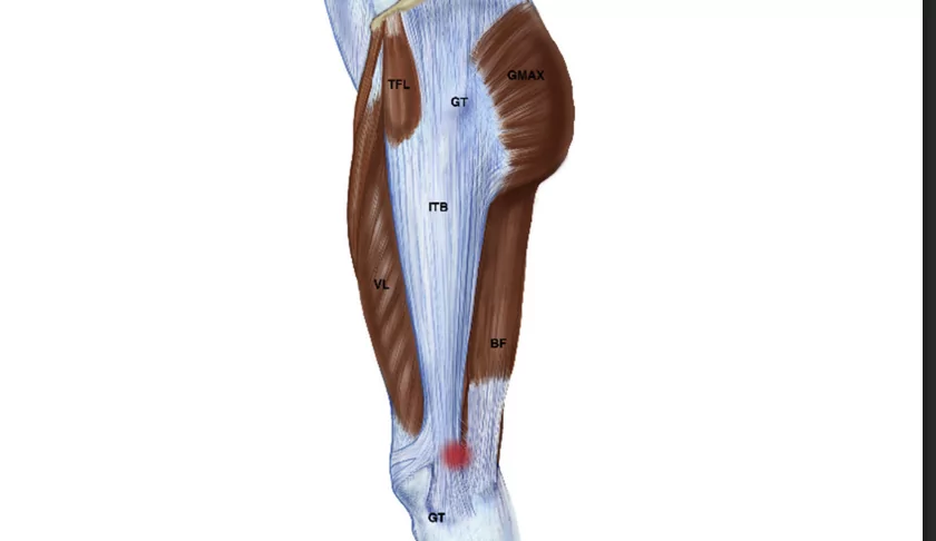 Síndrome cintilla iliotibial